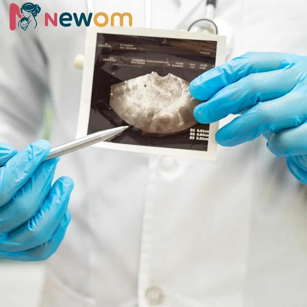 الحمل مع تكيس المبايض تجاربكم